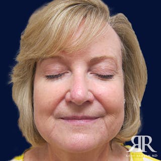 Mohs Surgery Before & After Gallery - Patient 396001 - Image 2