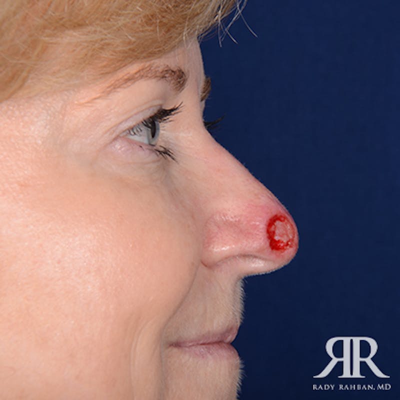 Mohs Surgery Before & After Gallery - Patient 396001 - Image 3