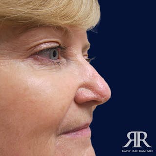 Mohs Surgery Before & After Gallery - Patient 396001 - Image 4