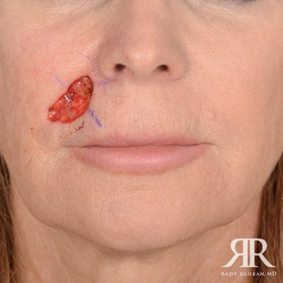 Mohs Surgery Before & After Gallery - Patient 160689 - Image 1