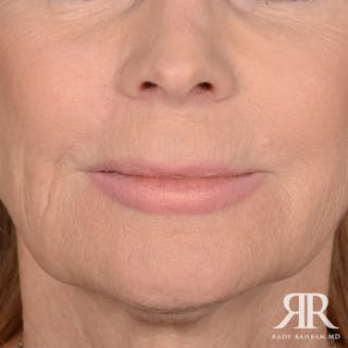 Mohs Surgery Before & After Gallery - Patient 160689 - Image 2