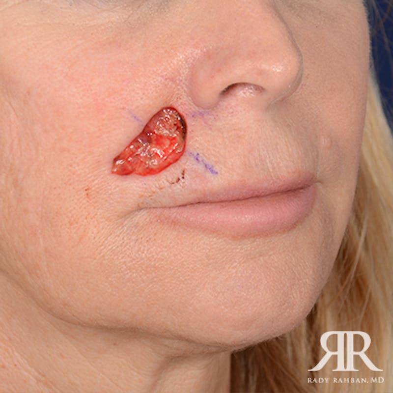 Mohs Surgery Before & After Gallery - Patient 160689 - Image 3