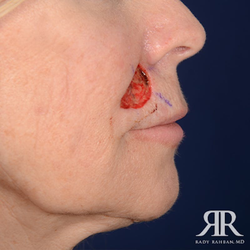 Mohs Surgery Before & After Gallery - Patient 160689 - Image 5