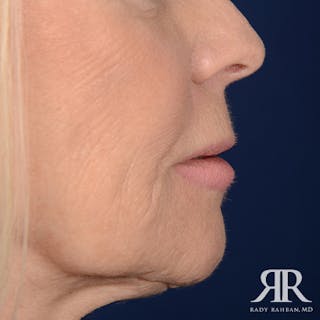 Mohs Surgery Before & After Gallery - Patient 160689 - Image 6