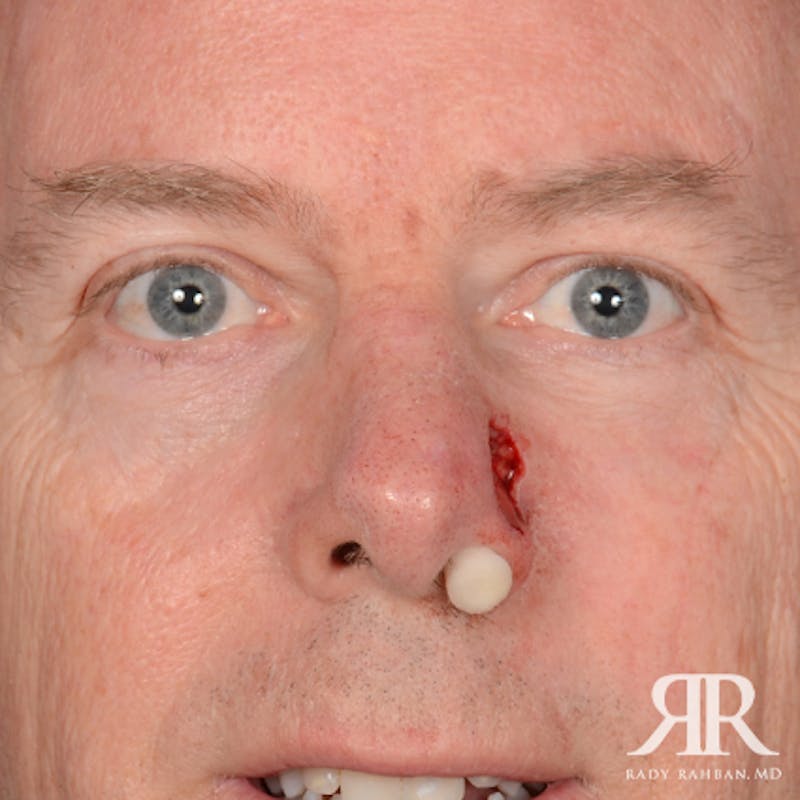 Mohs Surgery Before & After Gallery - Patient 282007 - Image 1