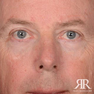 Mohs Surgery Before & After Gallery - Patient 282007 - Image 2