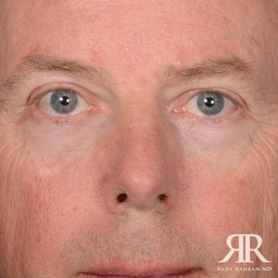 Mohs Surgery Before & After Gallery - Patient 282007 - Image 2