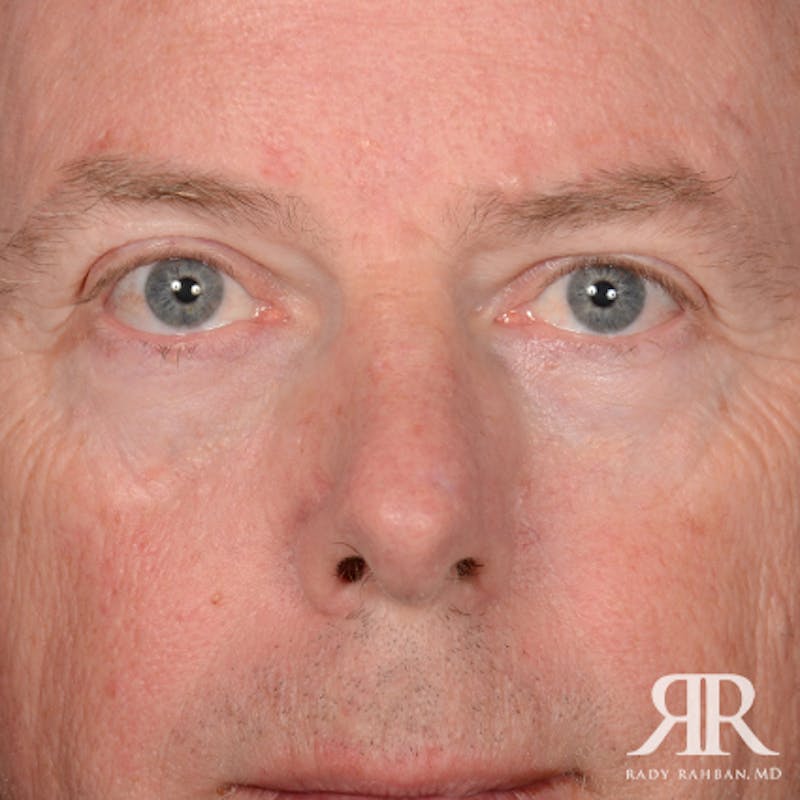 Mohs Surgery Before & After Gallery - Patient 282007 - Image 2