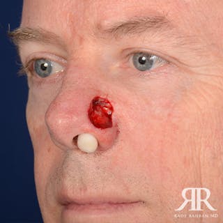 Mohs Surgery Before & After Gallery - Patient 282007 - Image 4