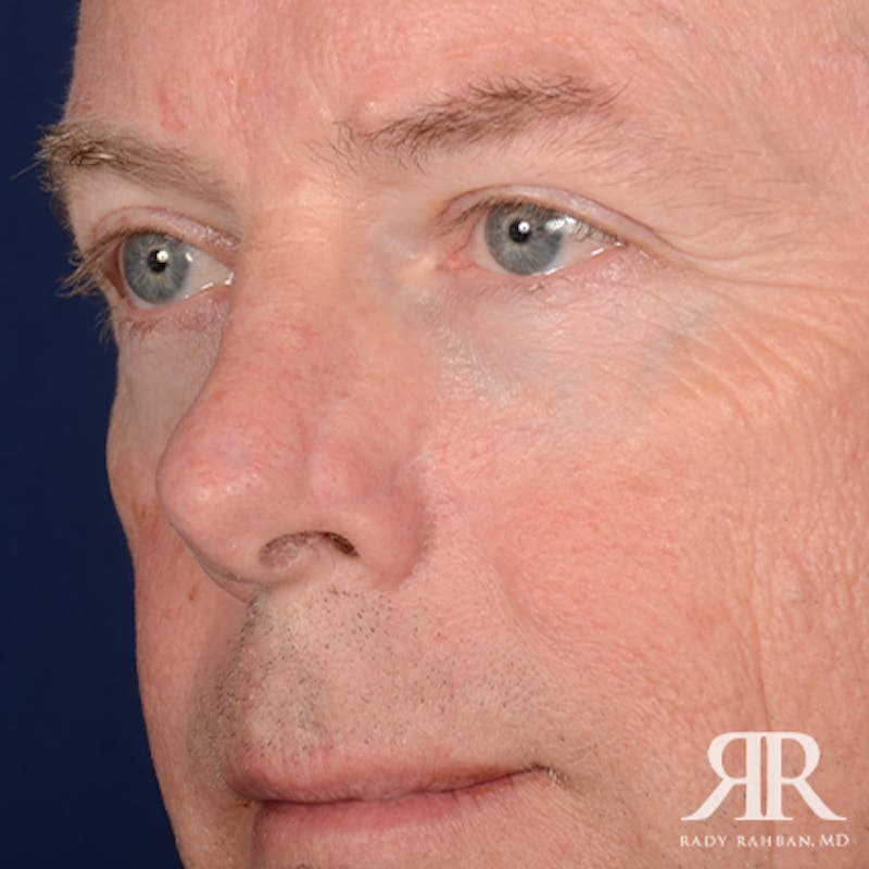 Mohs Surgery Before & After Gallery - Patient 282007 - Image 3