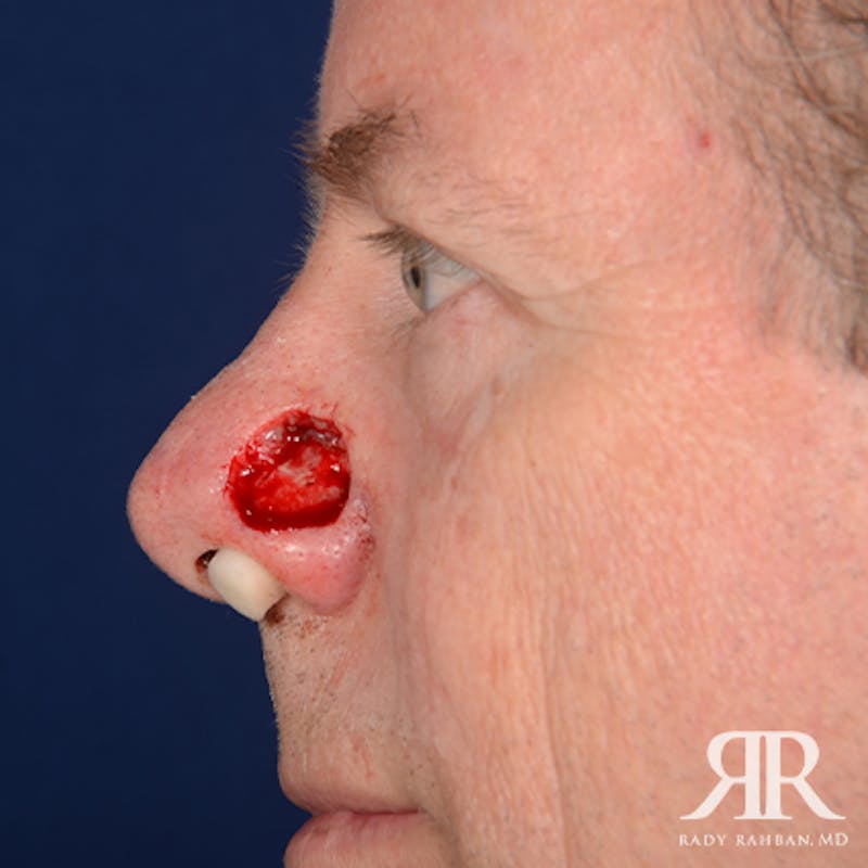Mohs Surgery Before & After Gallery - Patient 282007 - Image 5