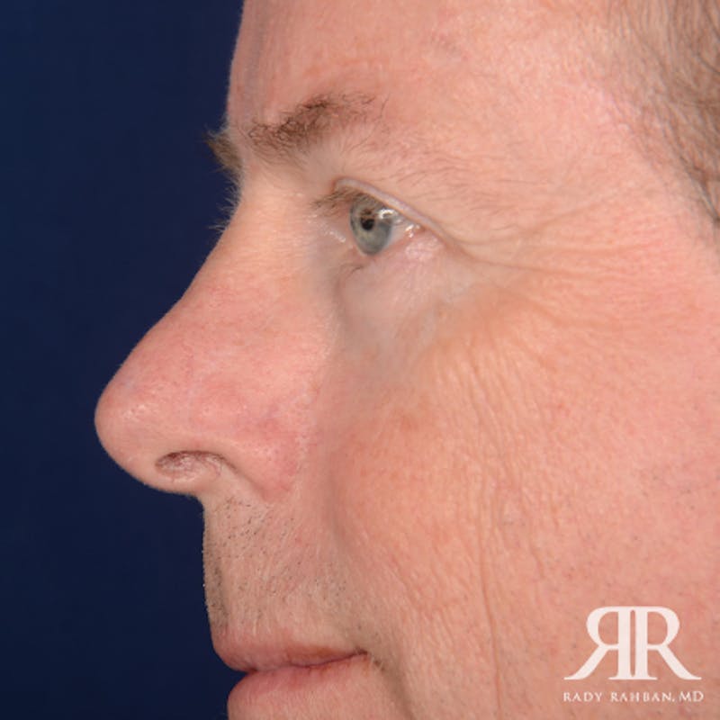 Mohs Surgery Before & After Gallery - Patient 282007 - Image 6