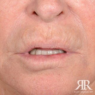 Mohs Surgery Before & After Gallery - Patient 341644 - Image 2
