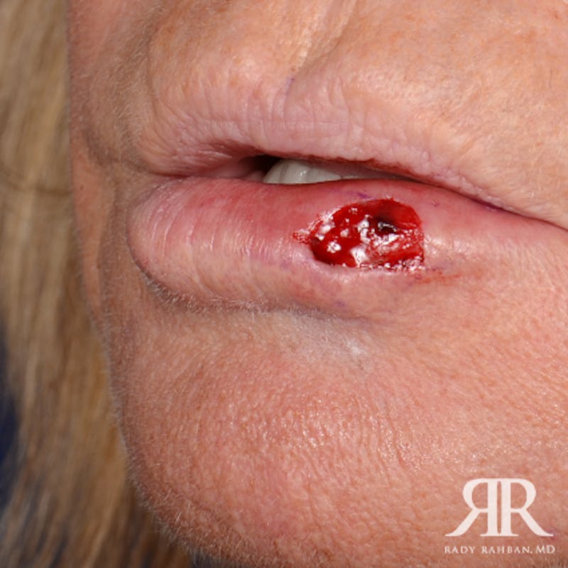 Mohs Surgery Before & After Gallery - Patient 341644 - Image 3
