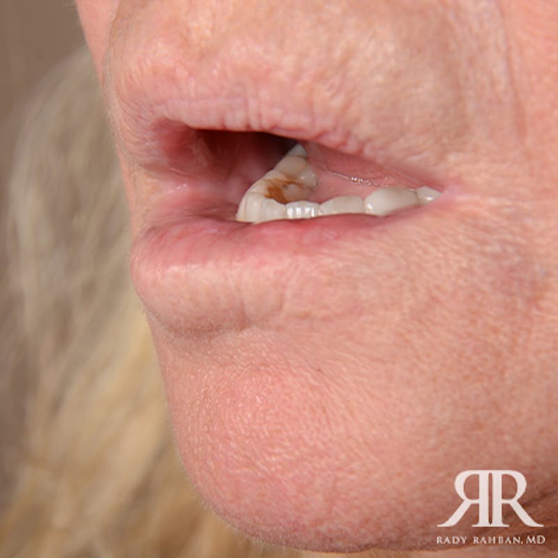 Mohs Surgery Before & After Gallery - Patient 341644 - Image 4