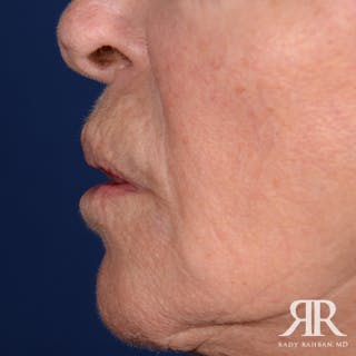 Mohs Surgery Before & After Gallery - Patient 341644 - Image 6