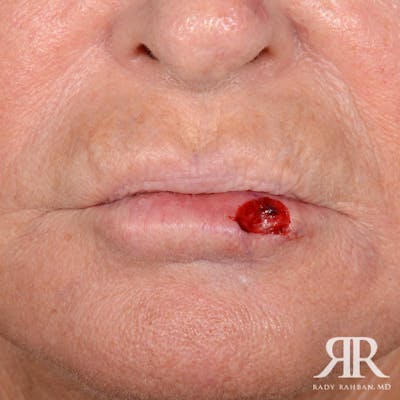 Mohs Surgery Before & After Gallery - Patient 341644 - Image 1