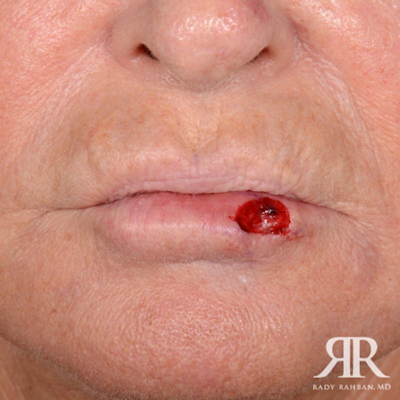 Mohs Surgery Before & After Gallery - Patient 341644 - Image 1