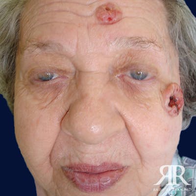 Mohs Surgery Before & After Gallery - Patient 398440 - Image 1