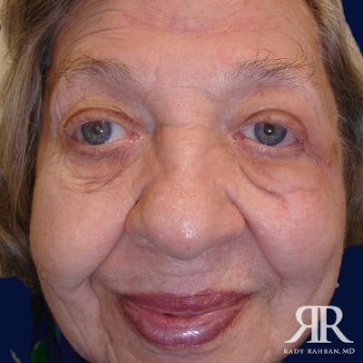 Mohs Surgery Before & After Gallery - Patient 398440 - Image 2