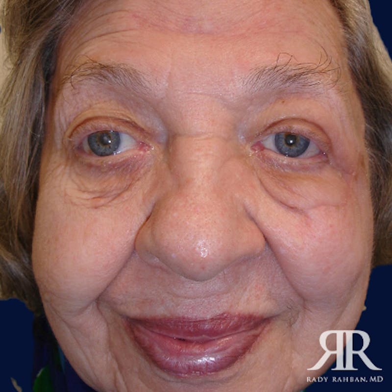 Mohs Surgery Before & After Gallery - Patient 398440 - Image 2