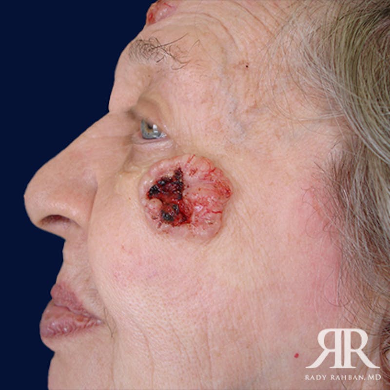 Mohs Surgery Before & After Gallery - Patient 398440 - Image 3