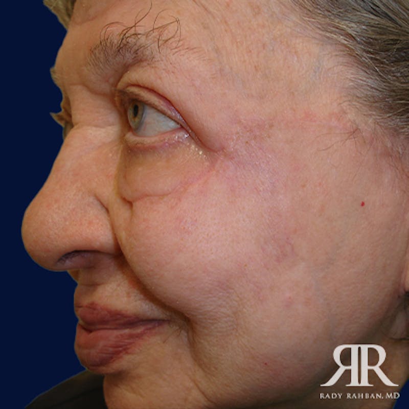 Mohs Surgery Before & After Gallery - Patient 398440 - Image 4