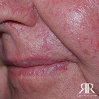 Mohs Surgery Before & After Gallery - Patient 387833 - Image 4