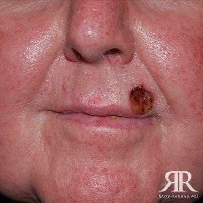 Mohs Surgery Before & After Gallery - Patient 387833 - Image 1