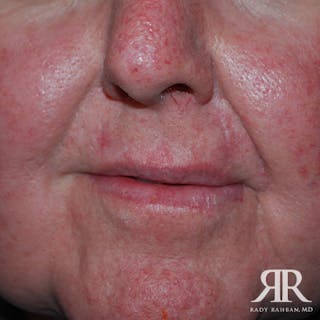 Mohs Surgery Before & After Gallery - Patient 387833 - Image 2