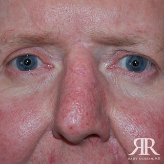 Mohs Surgery Before & After Gallery - Patient 174695 - Image 2