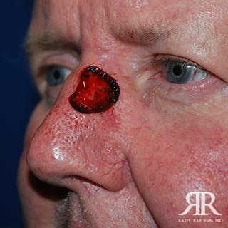 Mohs Surgery Before & After Gallery - Patient 174695 - Image 4