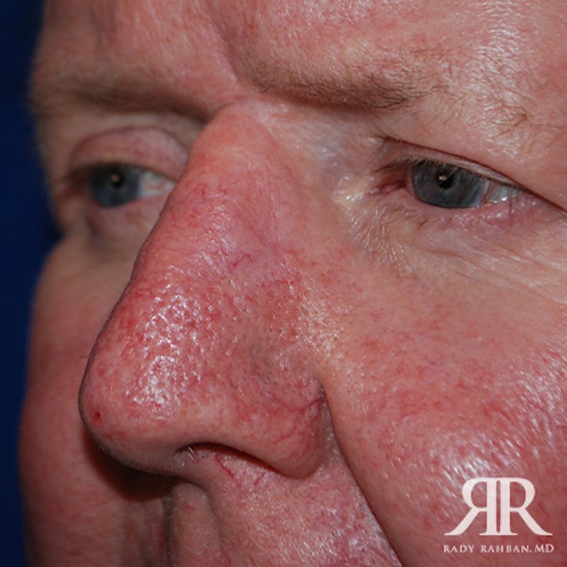 Mohs Surgery Before & After Gallery - Patient 174695 - Image 3