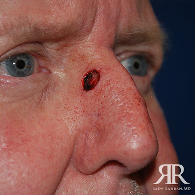 Mohs Surgery Before & After Gallery - Patient 174695 - Image 5