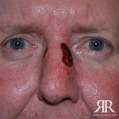 Mohs Surgery Before & After Gallery - Patient 174695 - Image 1