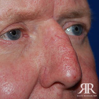 Mohs Surgery Before & After Gallery - Patient 174695 - Image 6