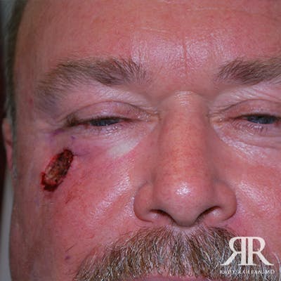 Mohs Surgery Before & After Gallery - Patient 101231 - Image 1