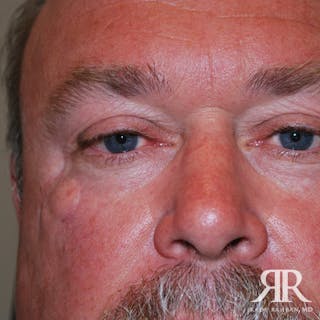 Mohs Surgery Before & After Gallery - Patient 101231 - Image 2