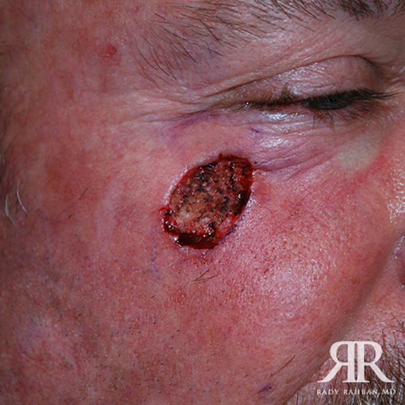 Mohs Surgery Before & After Gallery - Patient 101231 - Image 3