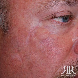 Mohs Surgery Before & After Gallery - Patient 101231 - Image 4