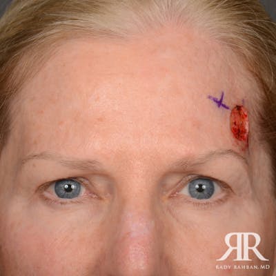 Mohs Surgery Before & After Gallery - Patient 108984 - Image 1