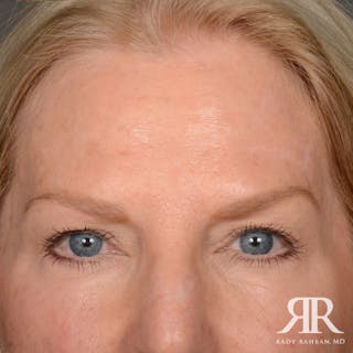 Mohs Surgery Before & After Gallery - Patient 108984 - Image 2