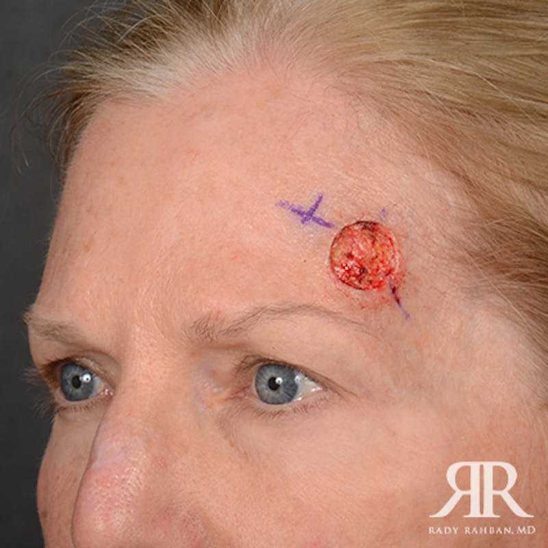 Mohs Surgery Before & After Gallery - Patient 108984 - Image 3