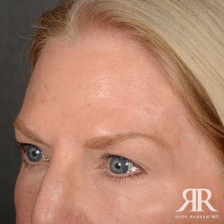 Mohs Surgery Before & After Gallery - Patient 108984 - Image 4