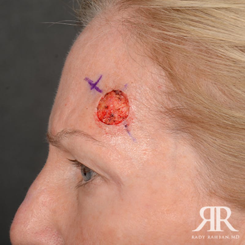 Mohs Surgery Before & After Gallery - Patient 108984 - Image 5