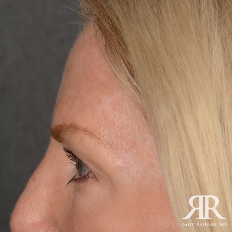 Mohs Surgery Before & After Gallery - Patient 108984 - Image 6