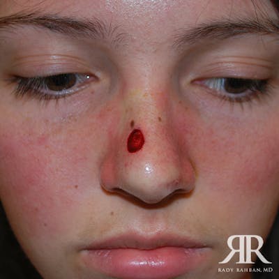 Mohs Surgery Before & After Gallery - Patient 131763 - Image 1
