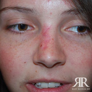 Mohs Surgery Before & After Gallery - Patient 131763 - Image 2