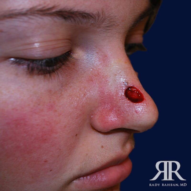 Mohs Surgery Before & After Gallery - Patient 131763 - Image 3