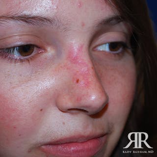 Mohs Surgery Before & After Gallery - Patient 131763 - Image 4